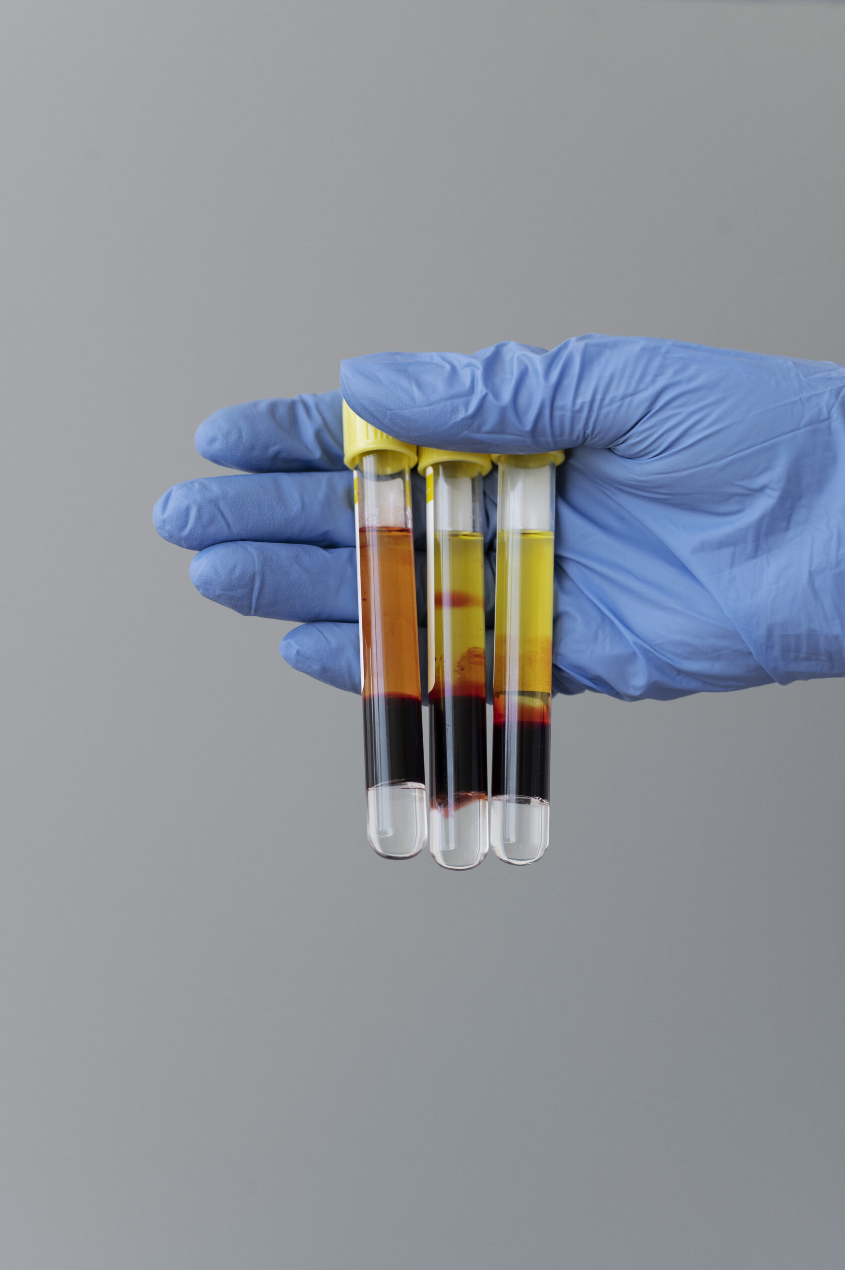 i-PRF preparation at GlowMedix Clinic