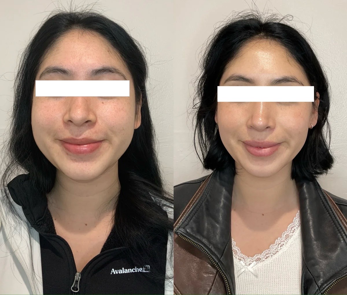 Botox London — masseter jaw slimming before and after at GlowMedix Clinic