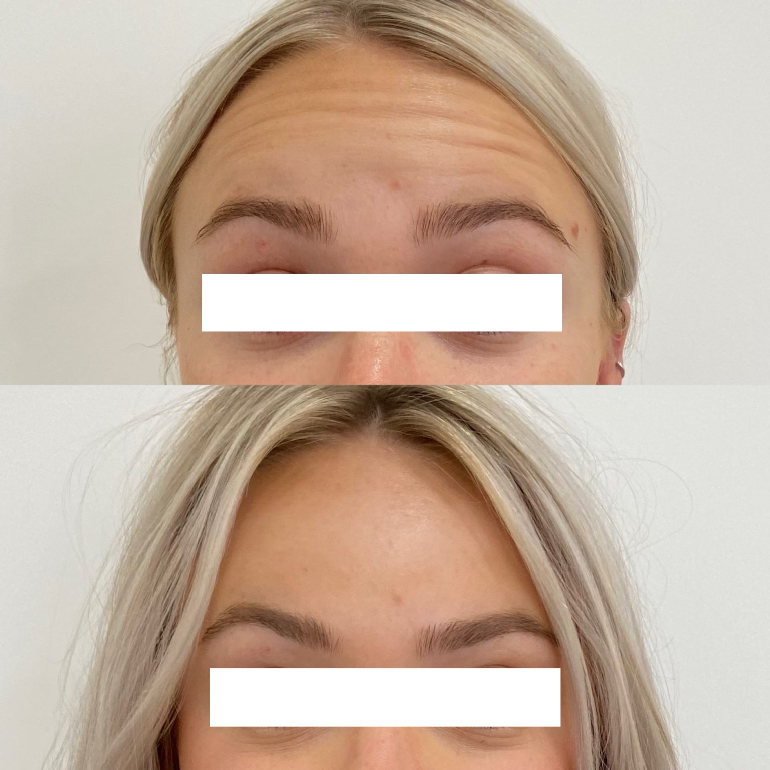 Botox London — glabella before and after at GlowMedix Clinic
