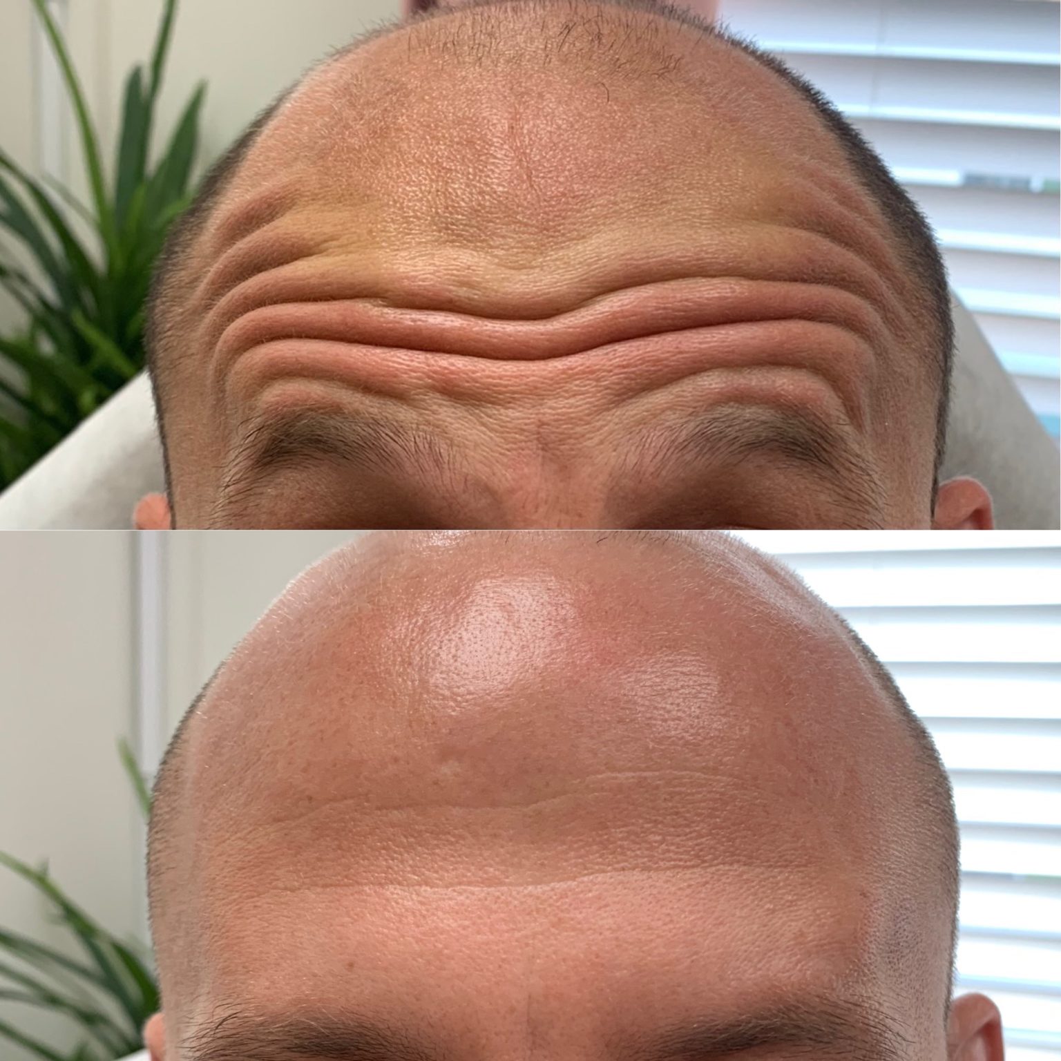 Modern Botox London techniques at GlowMedix Clinic