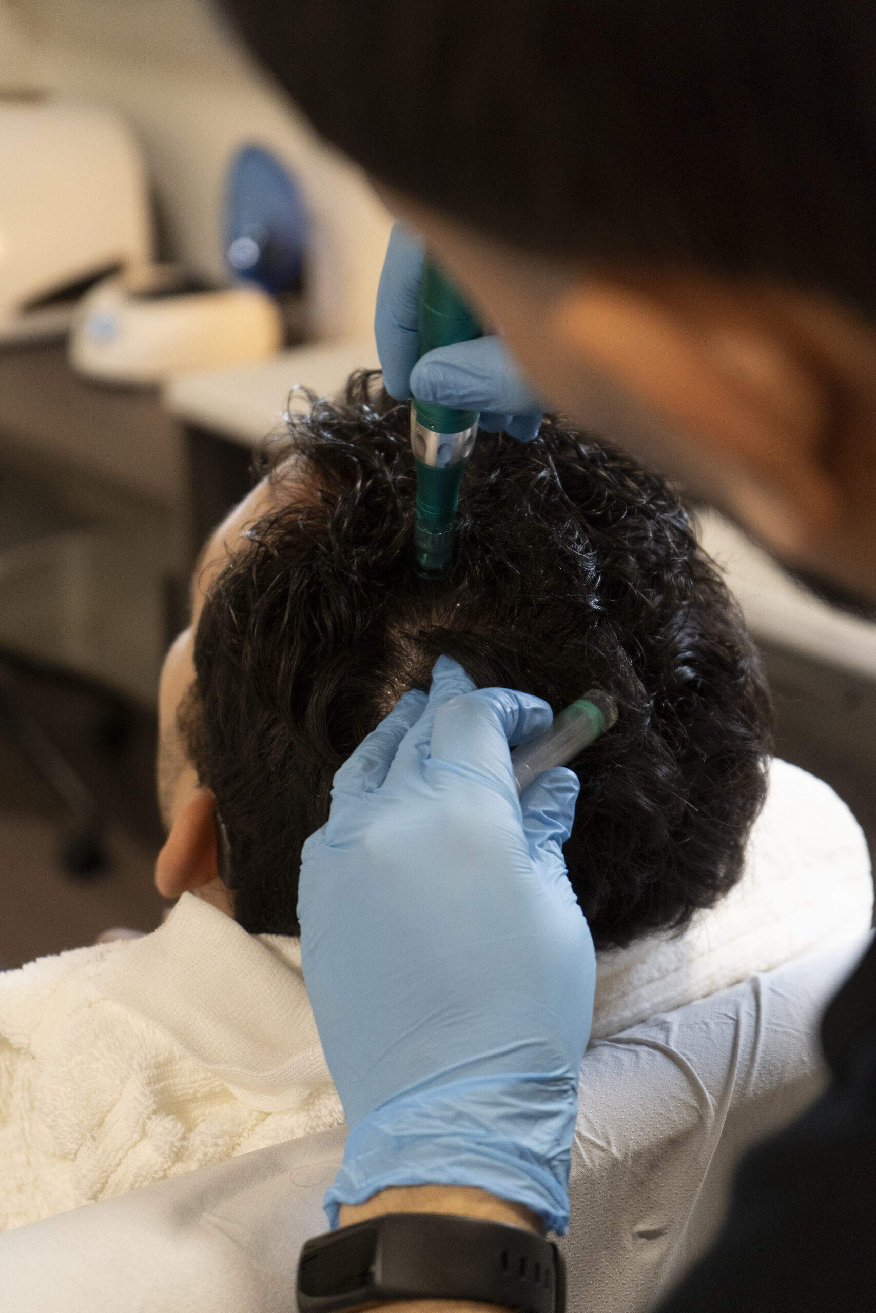 Hair exosome microneedling treatment at GlowMedix Clinic London