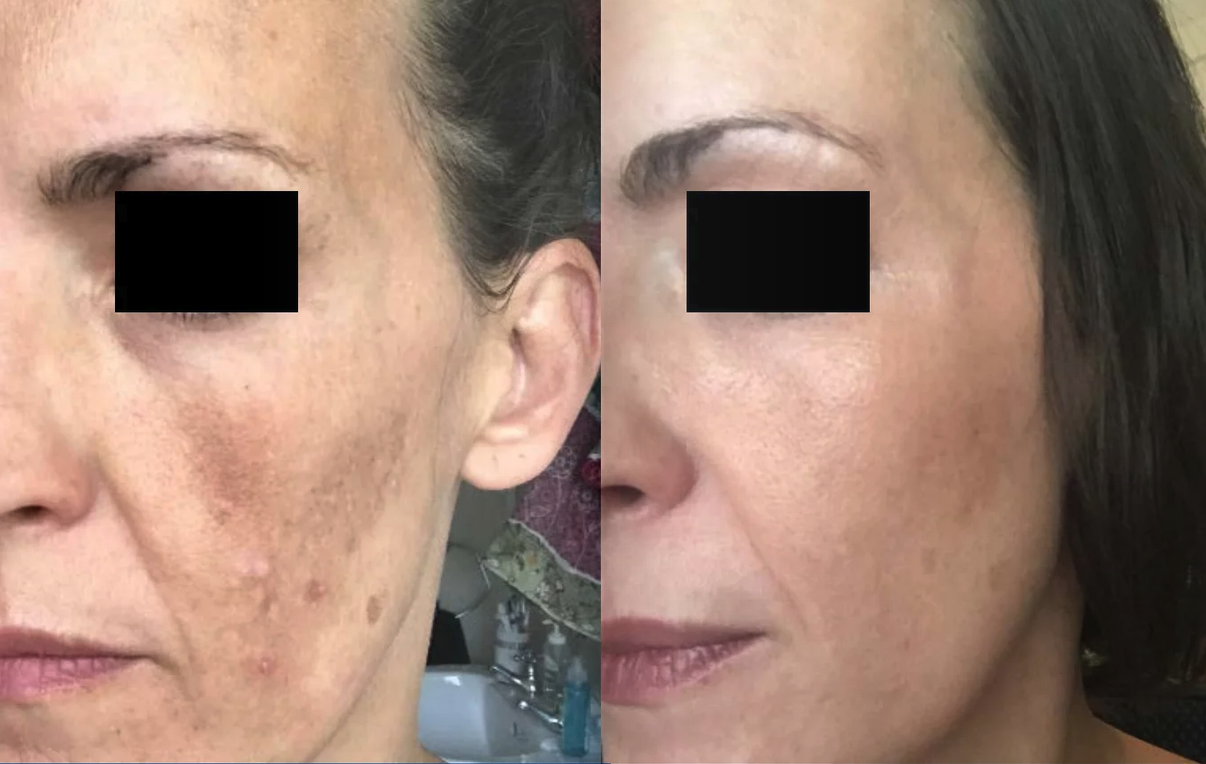 Medical grade skincare results — pigmentation before and after at GlowMedix Clinic London