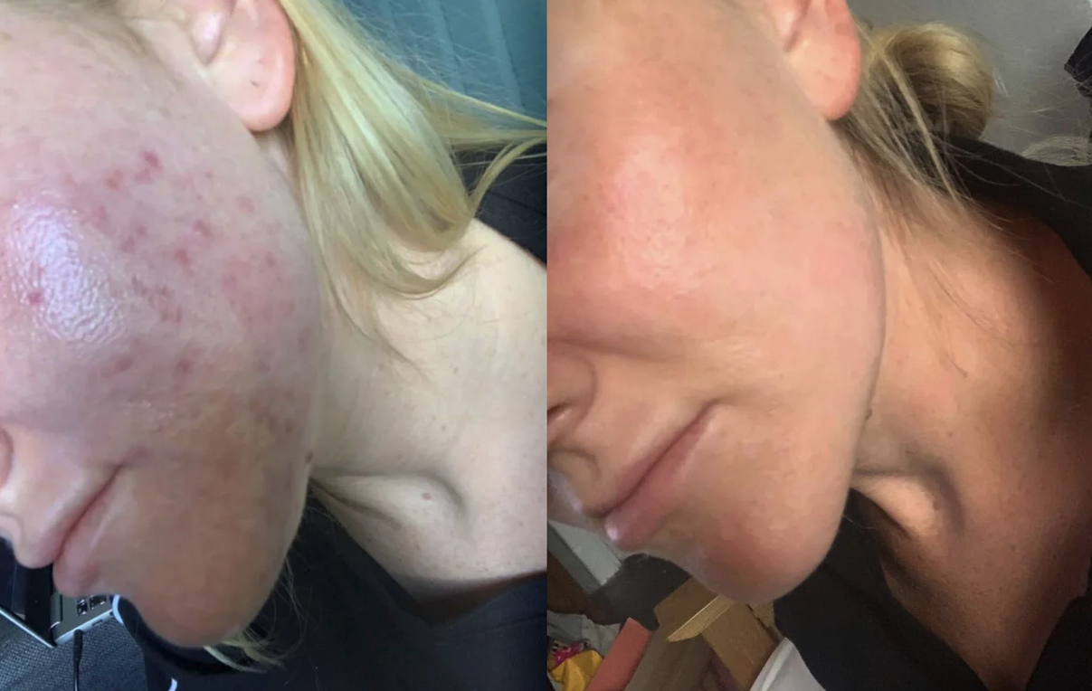 Medical grade skincare results — melasma before and after at GlowMedix Clinic London