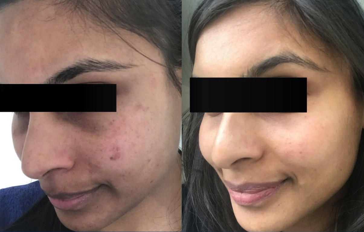 Medical grade skincare results — acne before and after at GlowMedix Clinic London