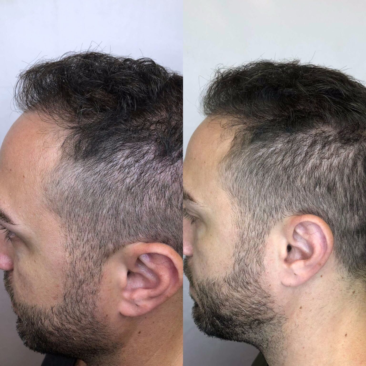 i-PRF hair restoration result — GlowMedix Clinic