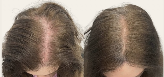 i-PRF hair restoration result — GlowMedix Clinic