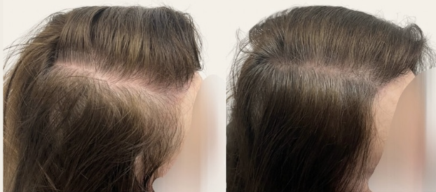 i-PRF hair restoration result — GlowMedix Clinic