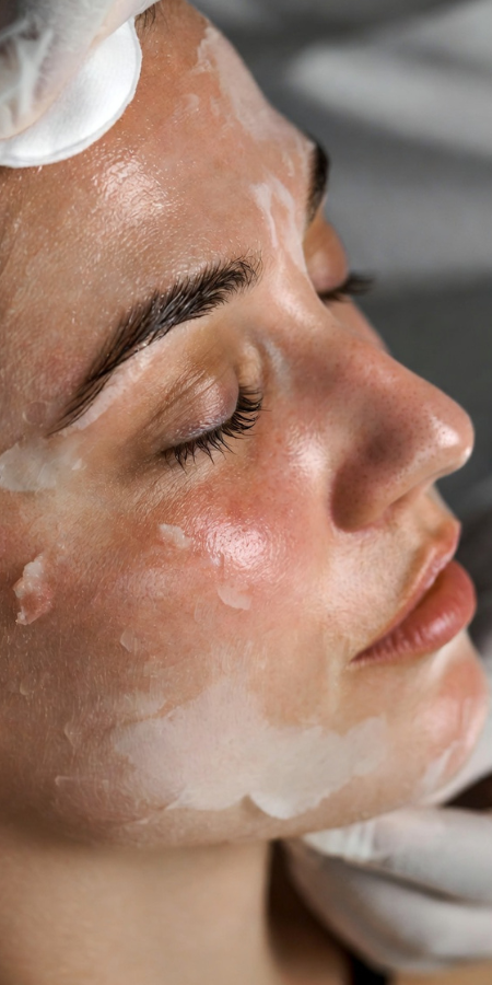 Medical-grade chemical peel at GlowMedix